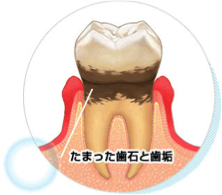 歯石と歯垢