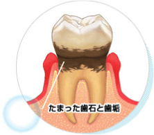 歯周病のお話 なぜ歯石を取らないといけないのか 名張市の歯医者 かめい歯科クリニック スタッフブログ