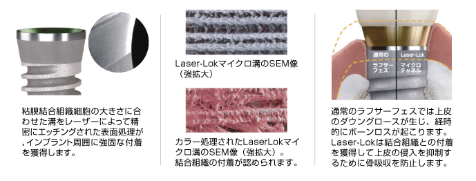 Laser-Lokインプラントとは…