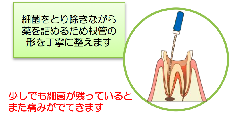 神経をとる って どういうこと ご存知ですか 根管治療 名張市の歯医者 かめい歯科クリニック スタッフブログ