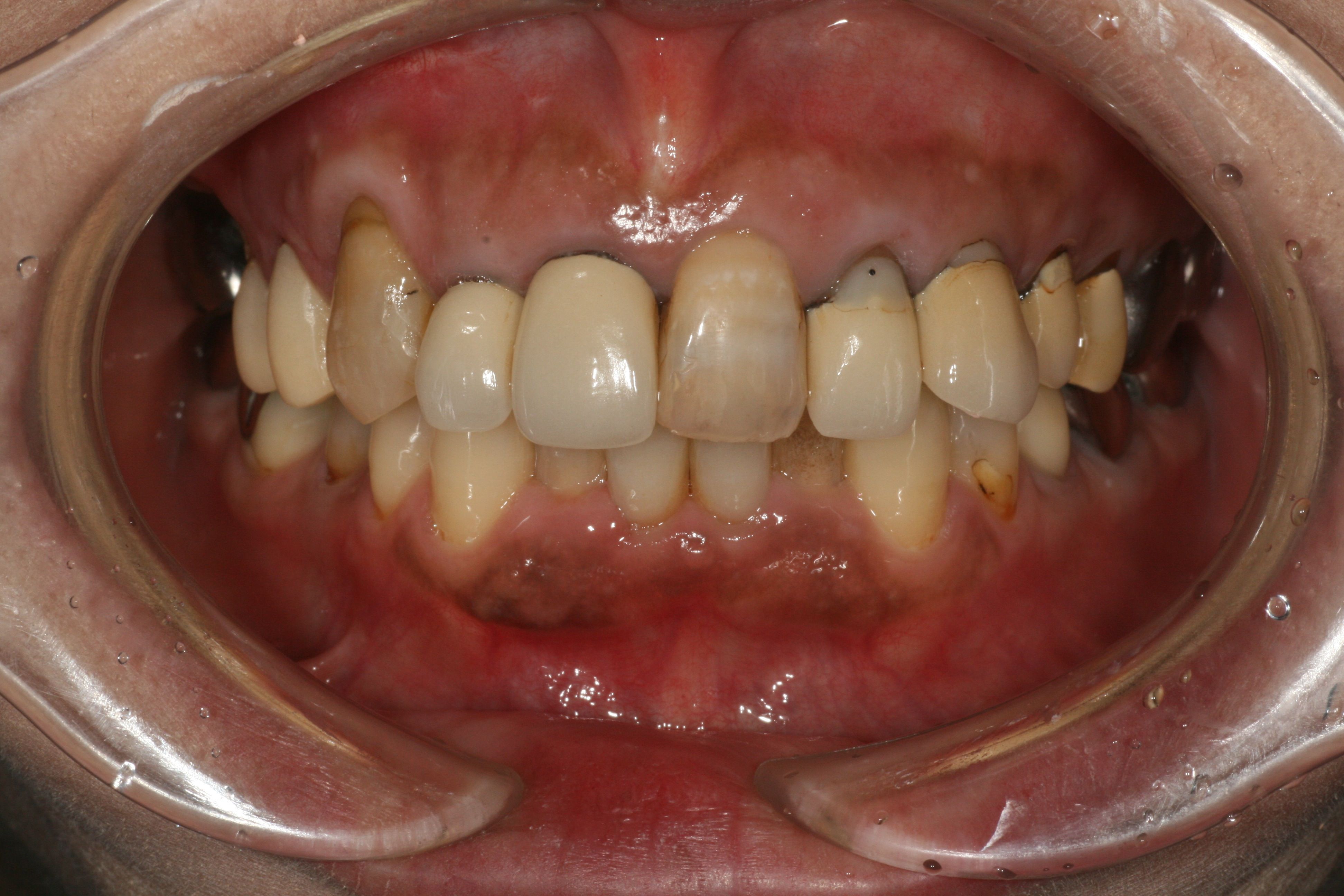 歯にコンプレックスがあり審美歯科を希望 金属アレルギーをセラミックで改善した40代女性 名張市の歯医者 かめい歯科クリニック スタッフブログ