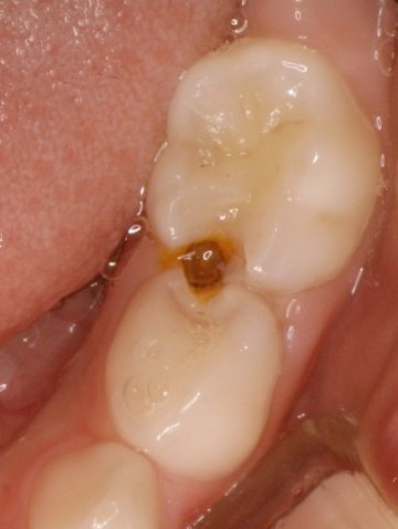 虫歯乳歯