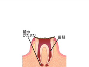 C4（歯根に虫歯が達する）