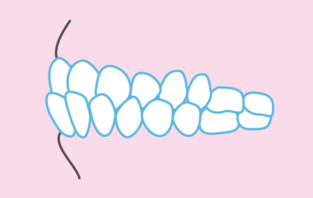 下の歯列が上の歯列よりも前に出ている、受け口で悩んでいる