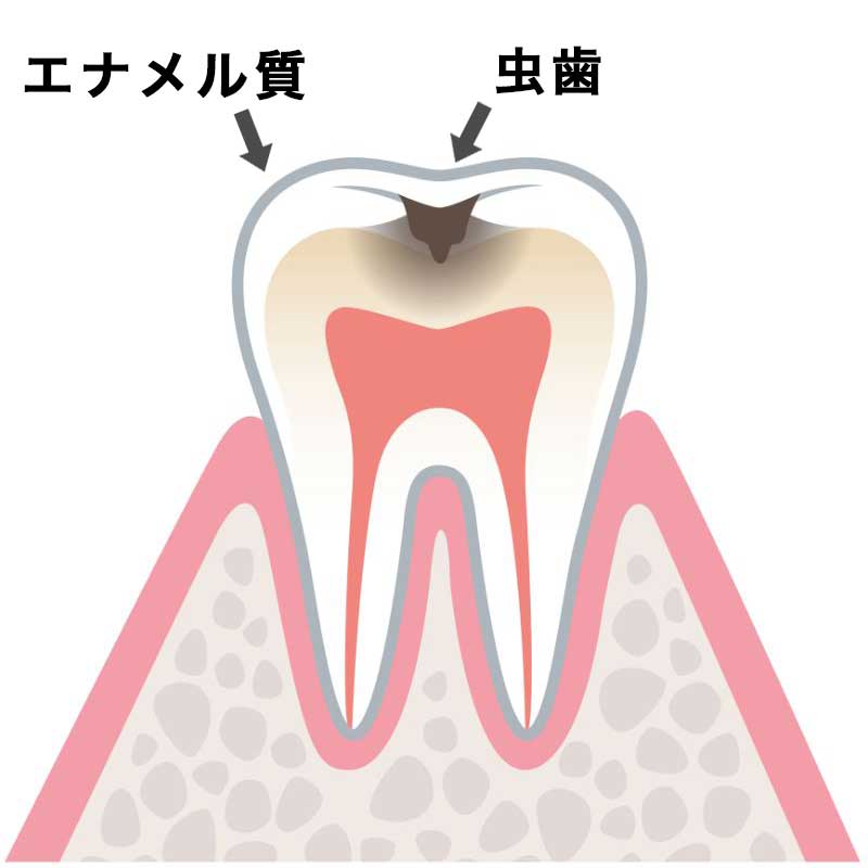 C1（エナメル質が虫歯）