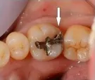 銀の詰めものが付いた歯の状態