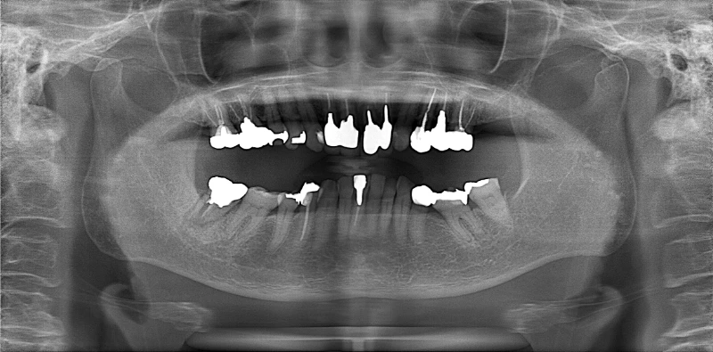 インプラント治療を受ける前の写真