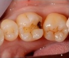 銀の詰め物を外した際の歯の状態