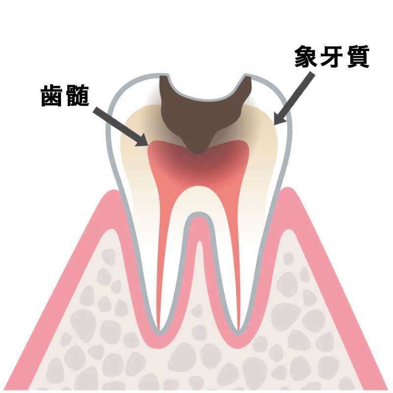 C2（象牙質が虫歯）
