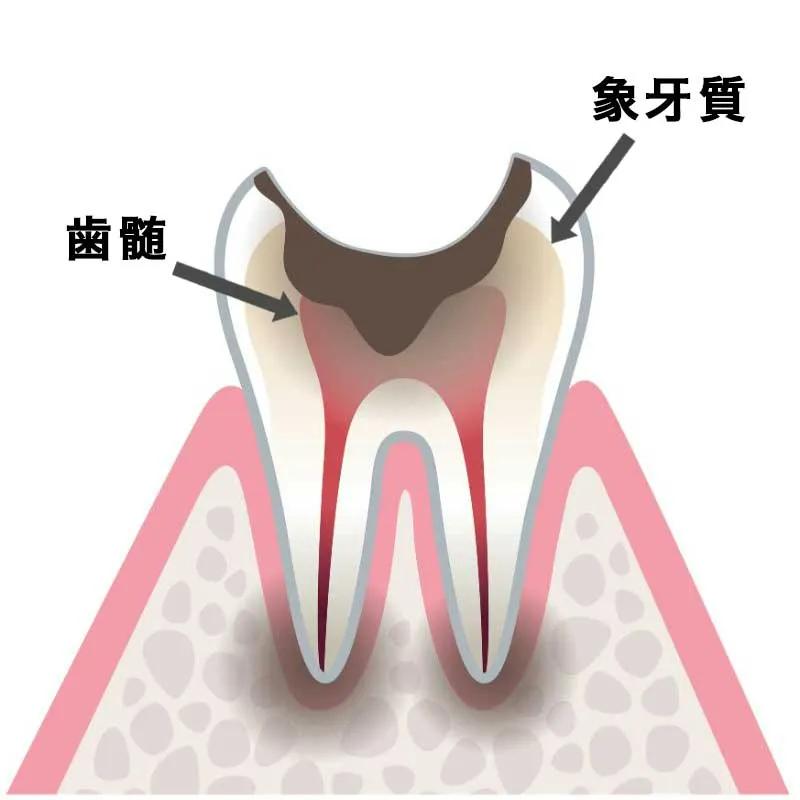 C3（虫歯が神経に達する）